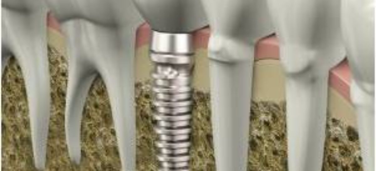 Dental Implants