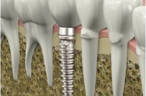 Dental Implants