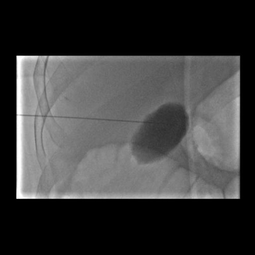 Laparoscopic Cholecystectomy Operative Technique