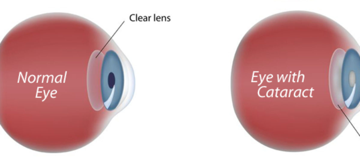 Things You Need to Know about Cataract Surgery