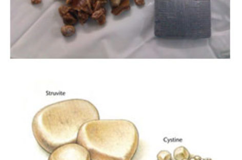 Urinary Stone Disease