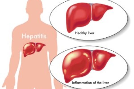 What is Hepatitis?