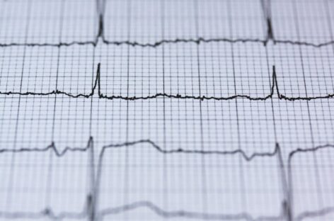 What Triggers Palpitations