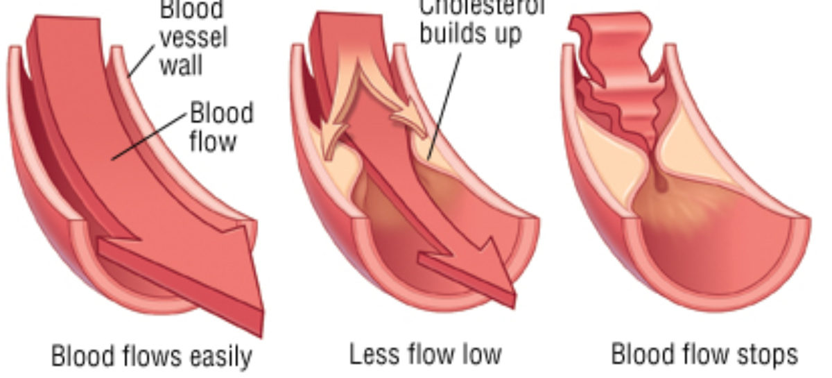 Causes of Blood Flow Obstruction in your body