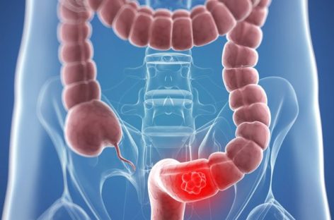 Colon Cancer – The threat is real