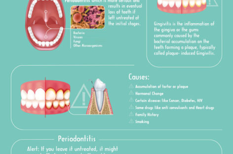 What is Gingivitis? – Infographic