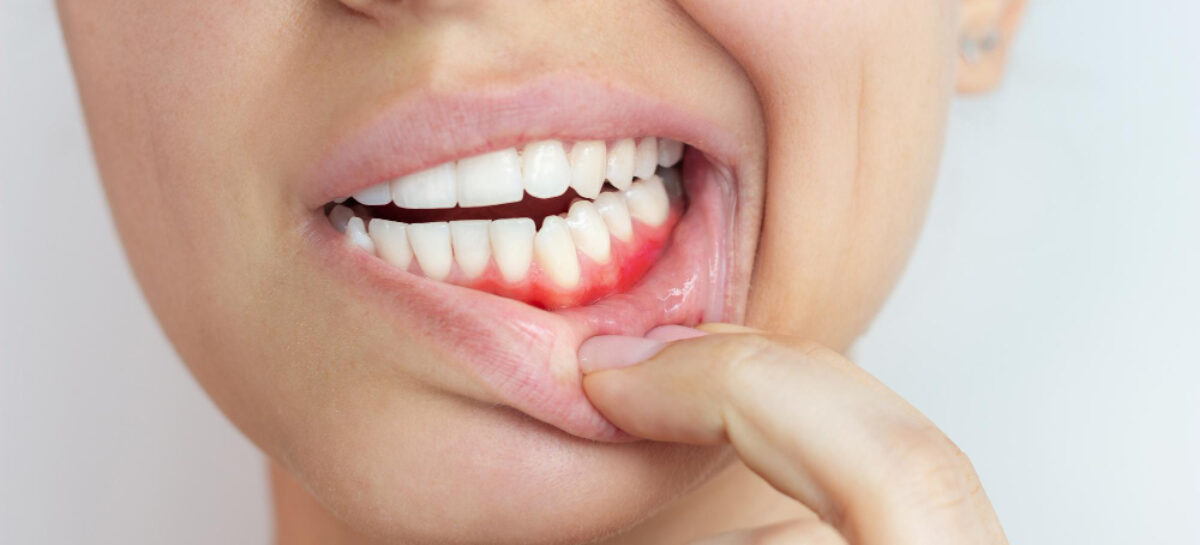 Bleeding Gums? Here’s Everything You Need to Know about Gingivitis