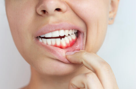 Bleeding Gums? Here’s Everything You Need to Know about Gingivitis