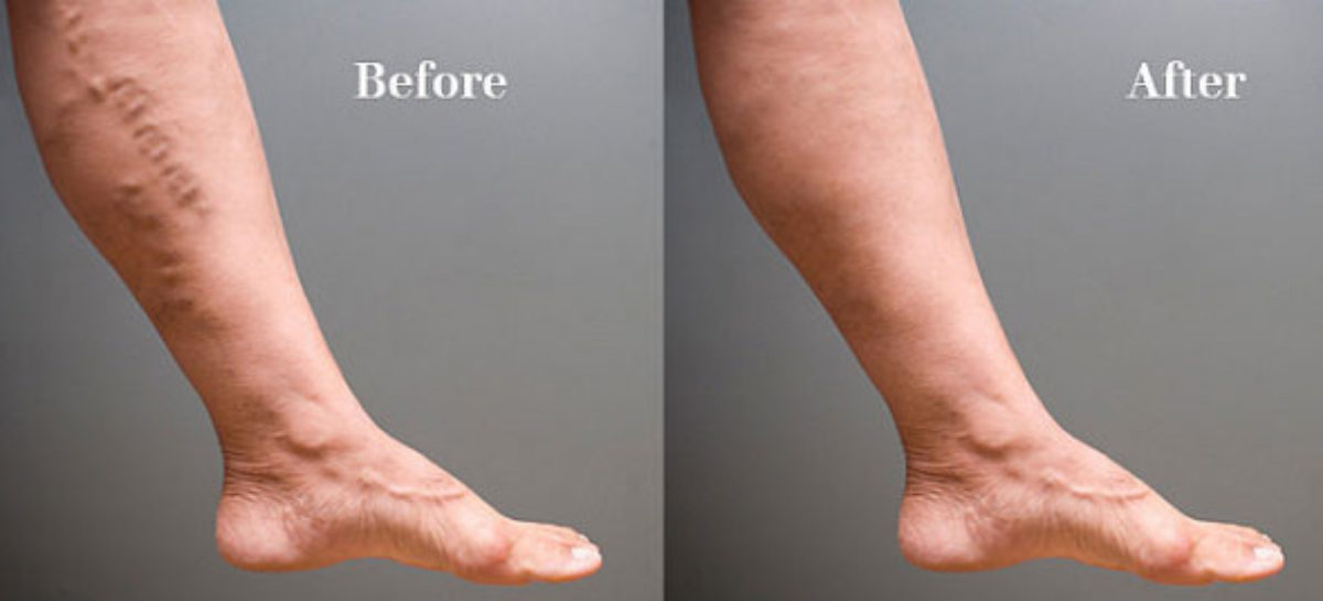 Varicose Veins – Causes And Treatment