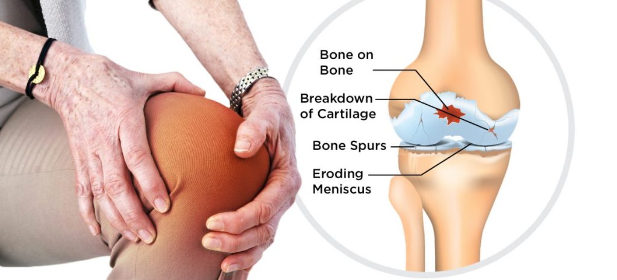 Causes, Symptoms and Treatment of Osteoarthritis
