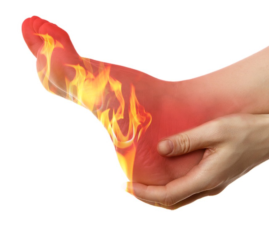 heel of foot burns