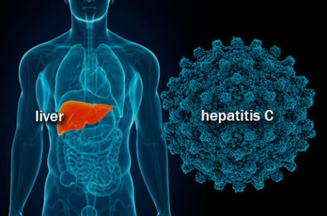 What causes Hepatitis C?