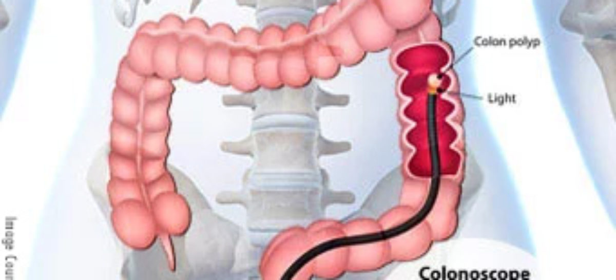 What is a Colonoscopy? Why is it done?