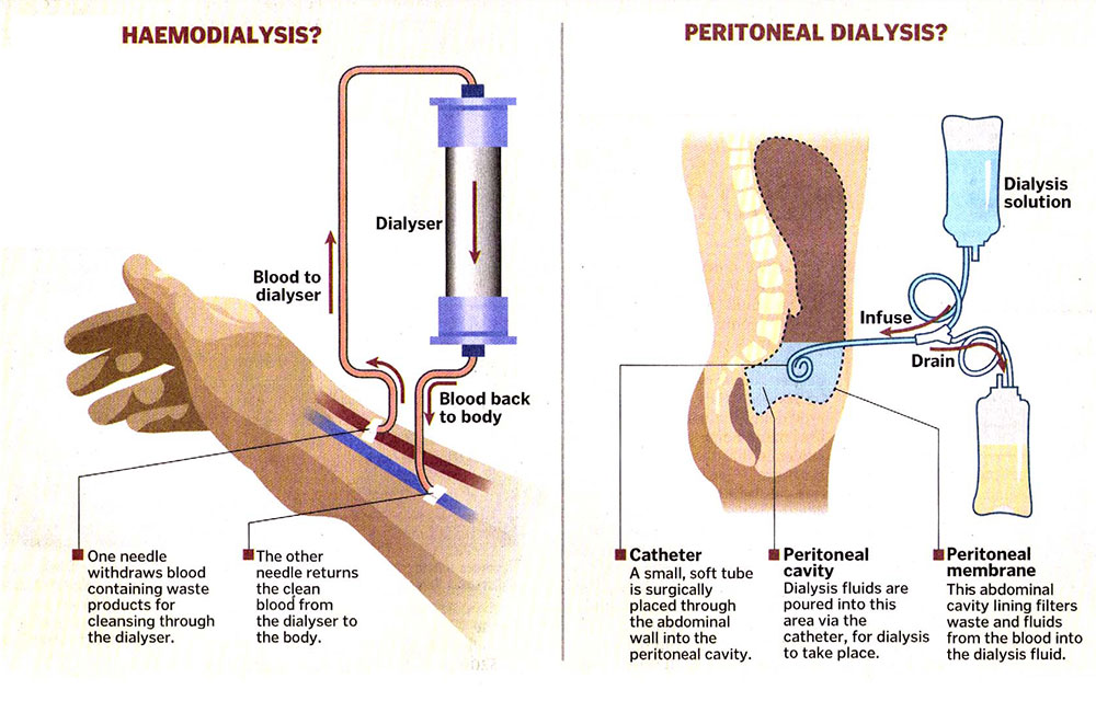 what-is-the-procedure-for-dialysis-kauvery-hospital