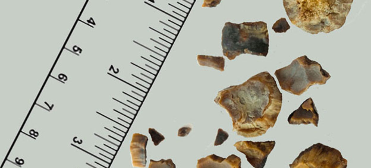 The Risk Factors In Developing Kidney Stones