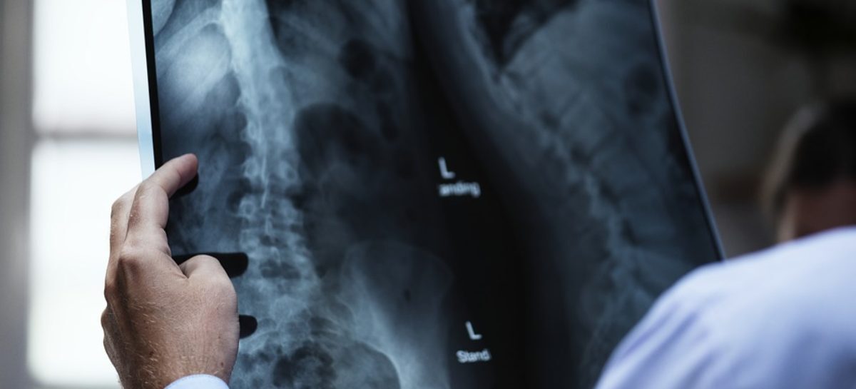 Screening and early Intervention for Spinal Deformities