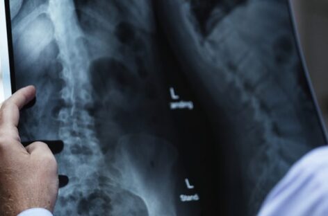 Screening and early Intervention for Spinal Deformities