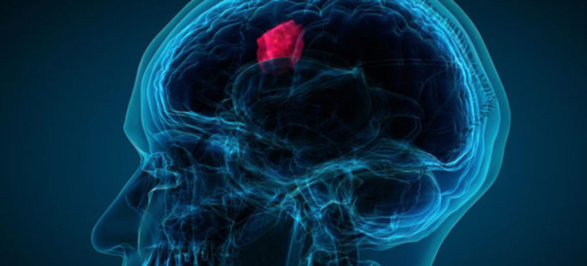 Recognize the warning signs of brain tumour, save a life