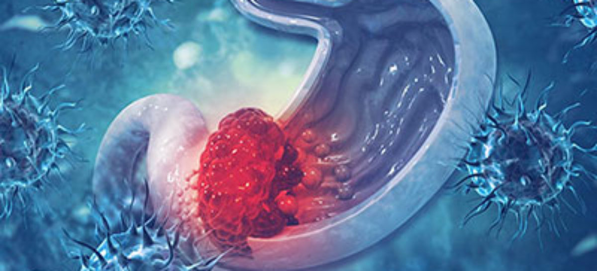 Stomach Cancer: Do not ignore these symptoms