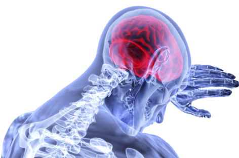 All About Brain Aneurysms