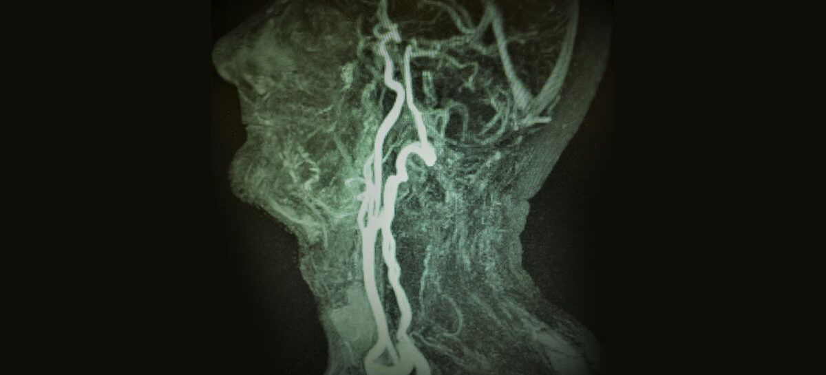 Symptoms of blocked Carotid Artery and treatment