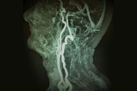Symptoms of blocked Carotid Artery and treatment