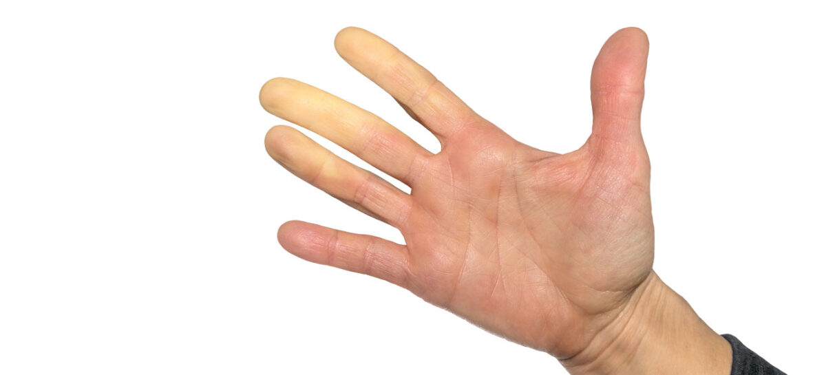 Raynaud’s disease- Causes and Symptoms