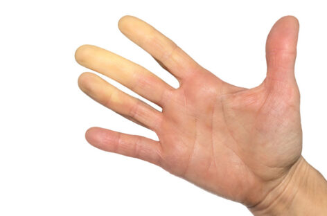 Raynaud’s disease- Causes and Symptoms