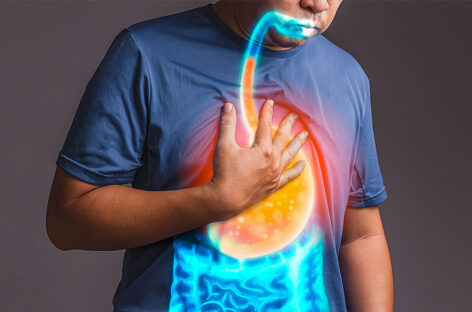 Medications and Diet Plan for Treatment of GERD