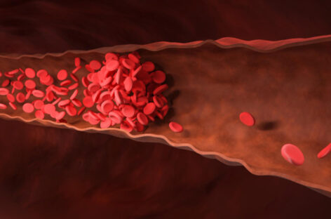 Blood Clots, how they form and common causes