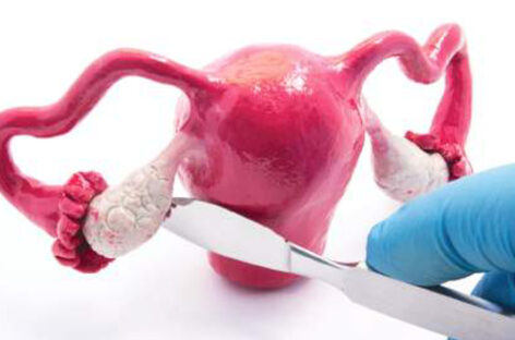 சினைப்பைப் புற்றுநோய் (ஓவரியன் கேன்சர்) – அறிகுறிகள் மற்றும் சிகிச்சை வழிகள்