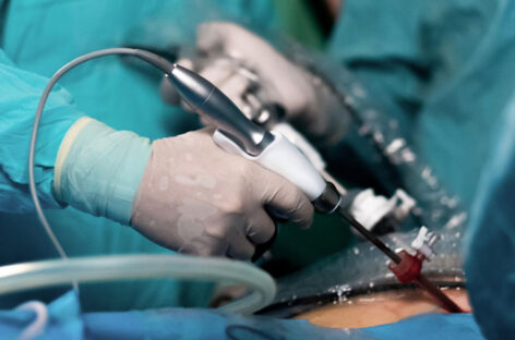 லேப்ராஸ்கோபி மூலம் பித்தப்பையை அகற்றுதல்