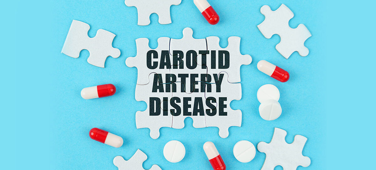 Carotid Artery Surgery When is Carotid Artery Surgery necessary? What is the success rate?