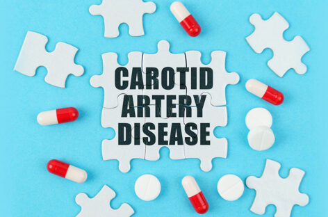 When is Carotid Artery Surgery necessary? What is the success rate?