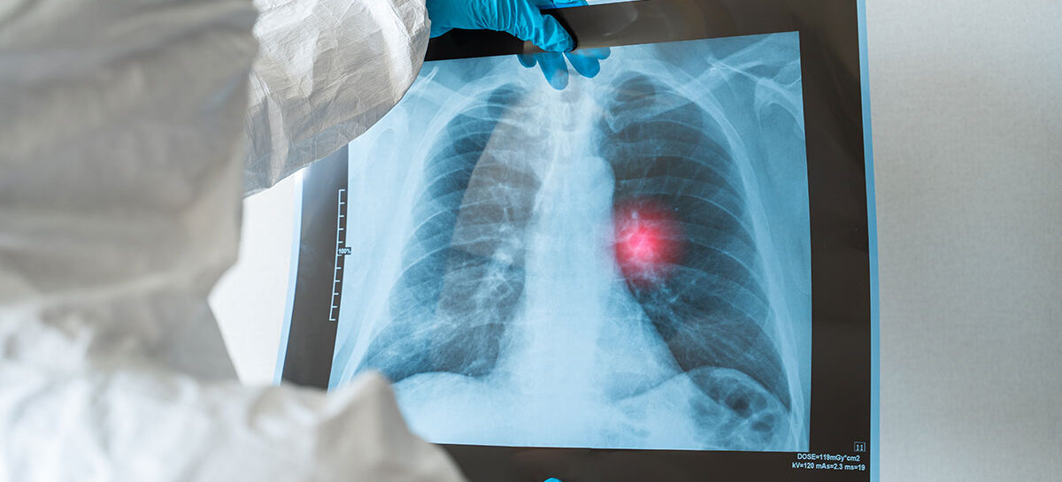 Lung Cancer Screening Tests – when does one need it?