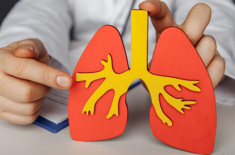 Bronchial Thermoplasty treatment for severe, persistent Asthma
