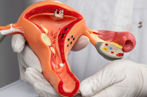 Hysteroscopy procedure for Gynaecologic Conditions