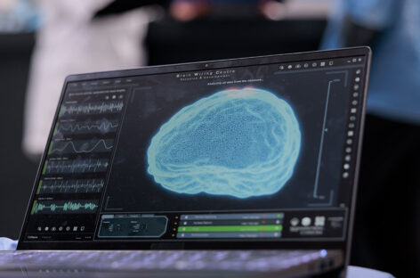 Deep Brain Simulations for the treatment of Parkinsons Disease