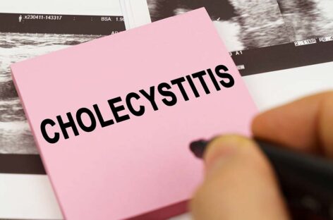 Understanding Cholecystitis Inflammation of the Gall Bladder