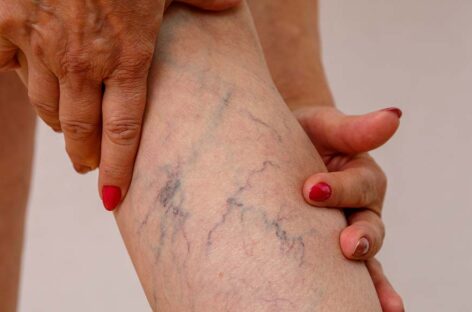Venous Insufficiency – Symptoms, Diagnosis and Treatment