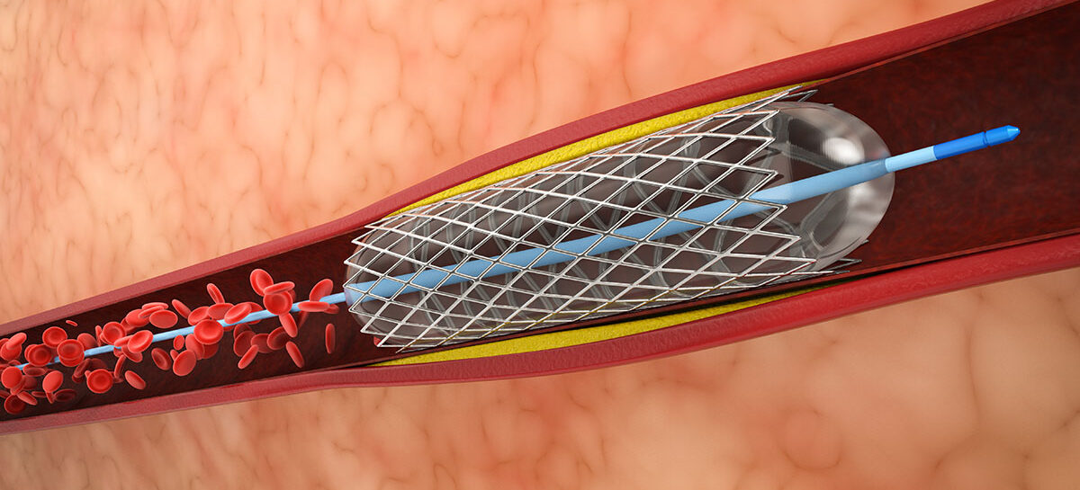 Is Angioplasty needed immediately after a Heart Attack?