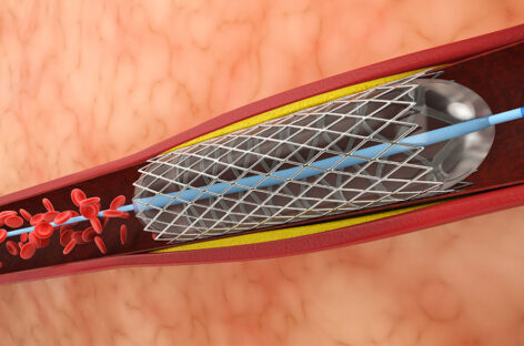 Is Angioplasty needed immediately after a Heart Attack?