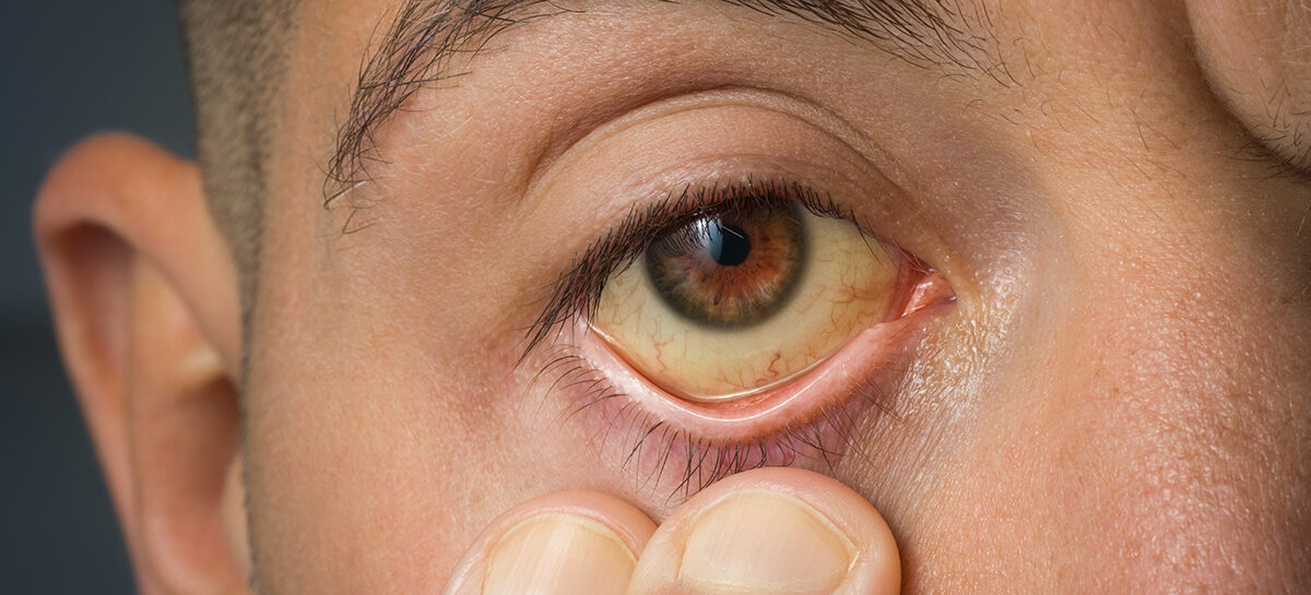 மஞ்சள் காமாலைக்கு நாட்டு மருந்துகள் ஆபத்து விளைவிக்கலாம்!