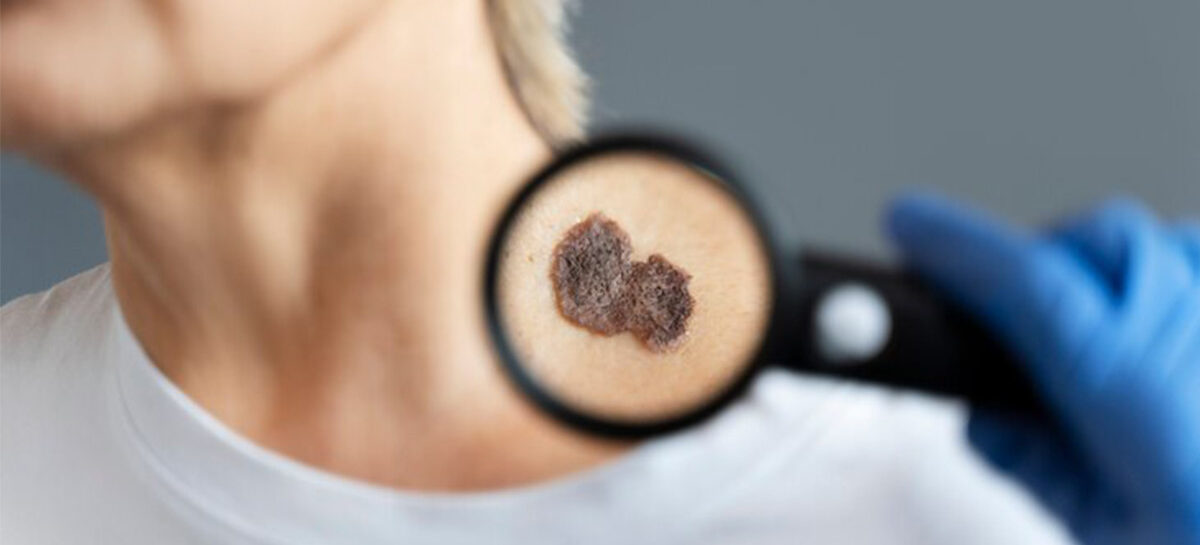 How to protect yourself from skin cancer