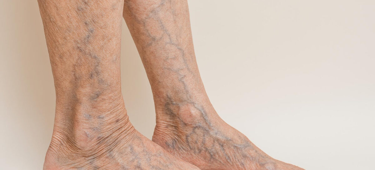 Varicose Veins and Knee Pain