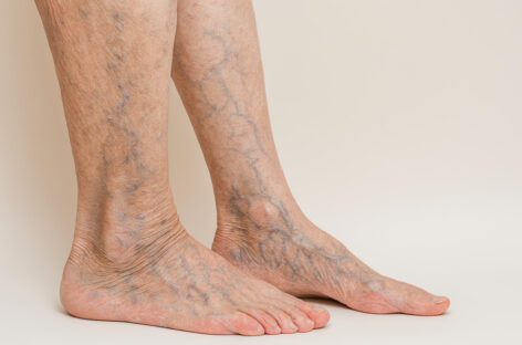 Varicose Veins and Knee Pain