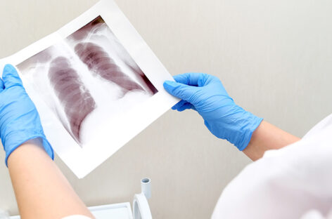 A Patient’s Guide to Bronchial Artery Embolization