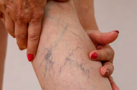 Varicose Veins and Knee Pain