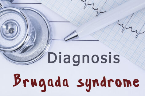 Brugada Syndrome – A Rare Genetic Heart Condition