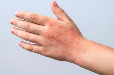 லூபஸ் எனும் தன்னுடல் தாக்குதல் நோய்